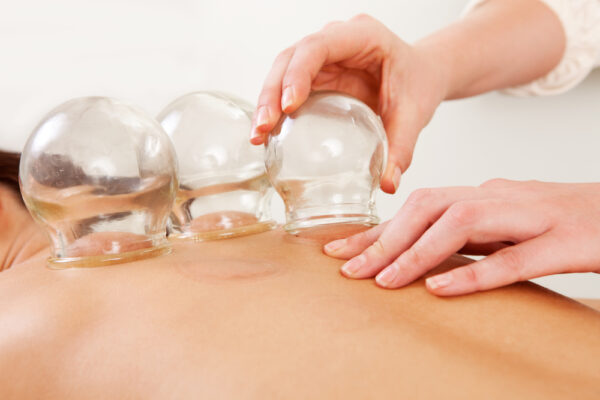 Cupping (Hijama) Therapy – Natural Healing Through Ancient Wisdom